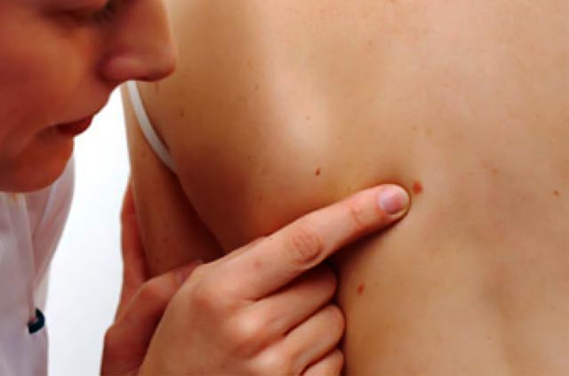 Καρκίνος του δέρματος:Τα σημάδια που προειδοποιούν  thumbnail