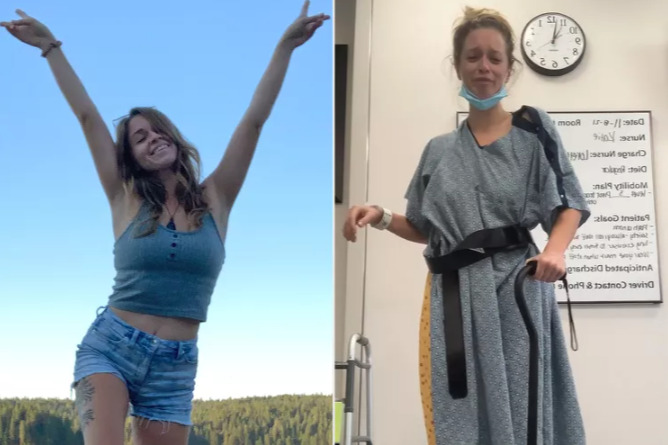 γυναίκα πριν και μετά από παρενέργειες που της προκάλεσε ένα αντιβιοτικό