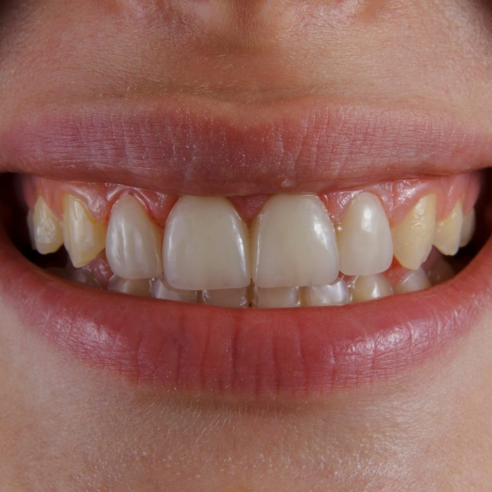 ozkan-guner-teeth-smile-unsplash